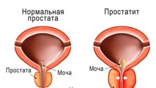 Семь популярных мифов о простатите